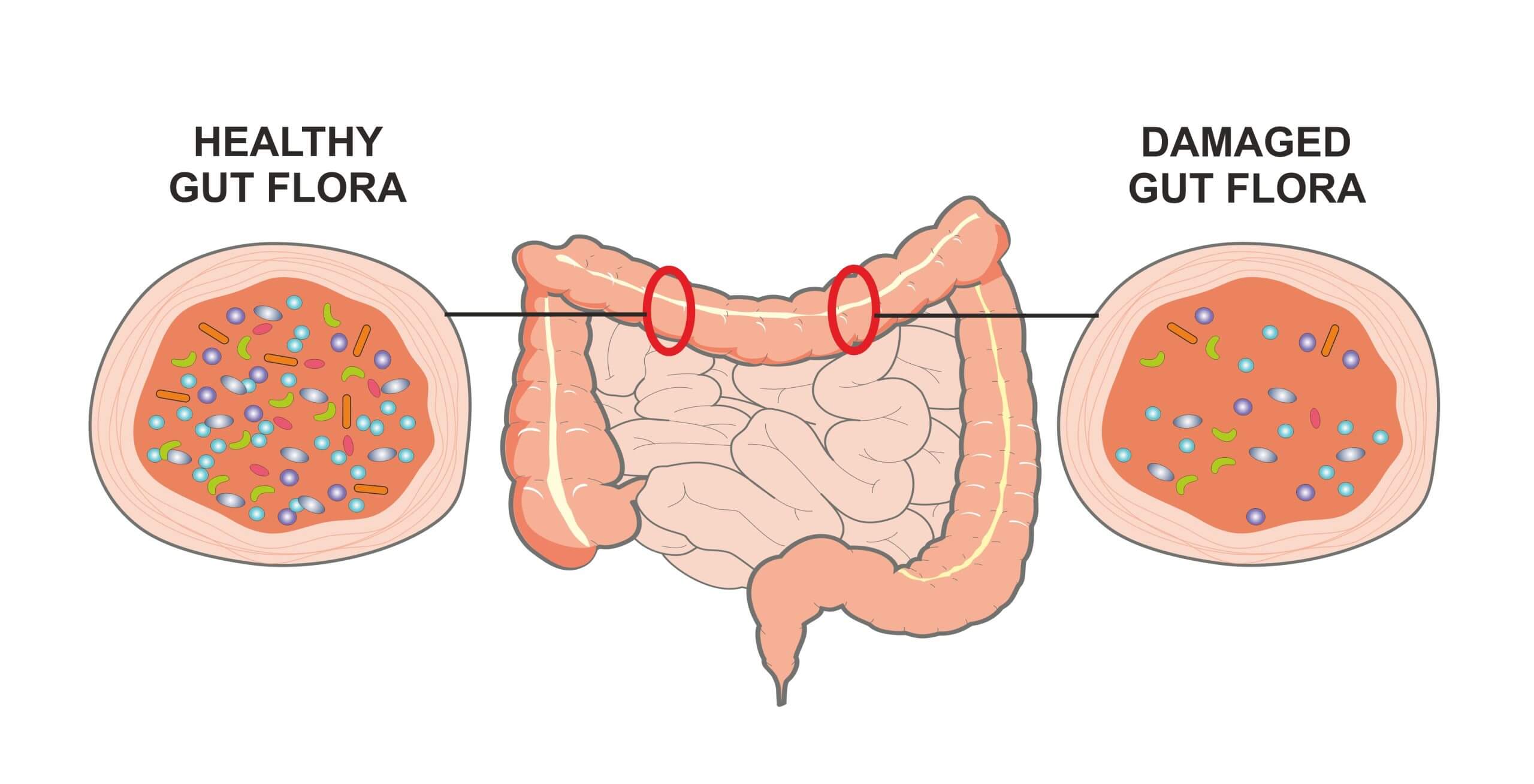 Damaged gut vs Healthy Gut